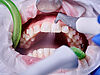 Zähne mit Zahnspange werden gereinigt