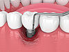 3D-Darstellung von Zahnimplantat
